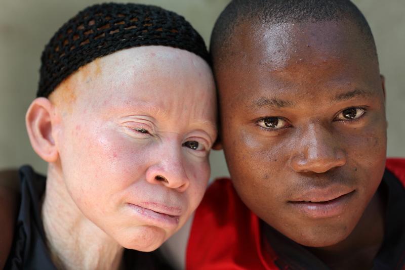 Carnicería humana: el drama de ser albino en África-0